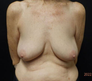 Breast Lift (Mastopexy)