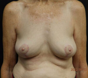 Breast Lift (Mastopexy)