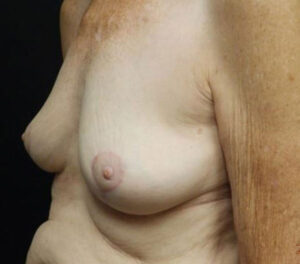 Breast Lift (Mastopexy)