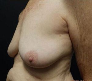 Breast Lift (Mastopexy)